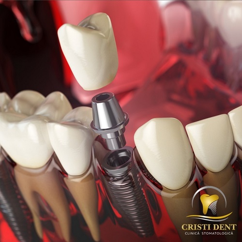 Бесплатные консультации и рентген в Кишиневе - стоматология от Cristi Dent