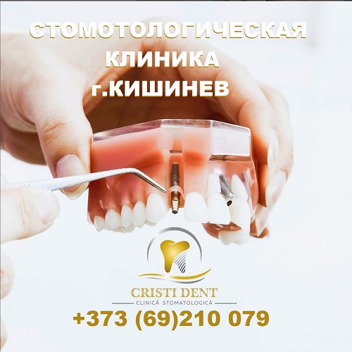 Идеальная улыбка с имплантами в Кишиневе - стоматологическая поликлиника Рышкановка.